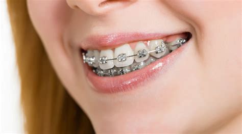 como se colocan los brackets metalicos|brackets dientes.